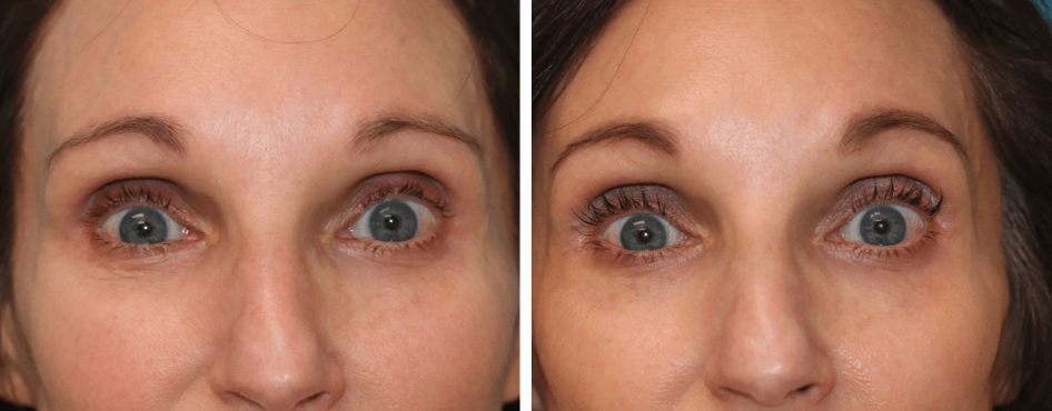 Screen Shot 2025-03-24 at 11.32.58 AM Before and after EZ PRF treatment in Princeton NJ
