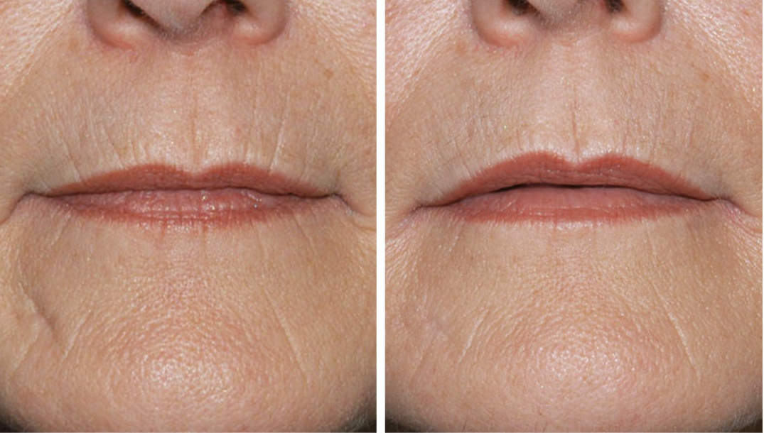 Screen Shot 2025-03-28 at 11.42.49 AM patient before and after Thermage skin tightening results in Princeton, NJ