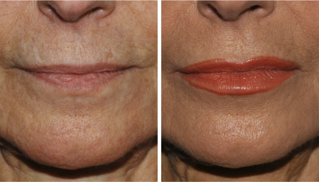 Screen Shot 2025-03-28 at 11.48.22 AM SmartLipo before and after photos