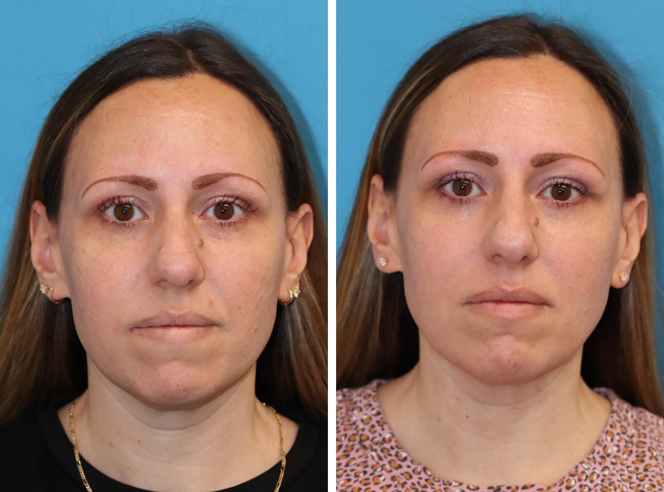 Before and after Quantum RF Microneedling in Princeton