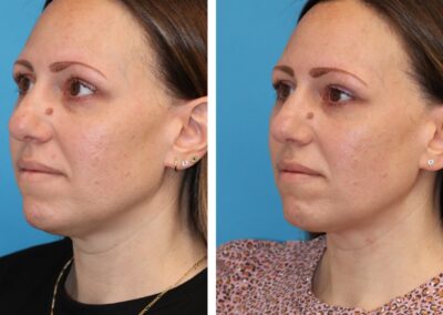 Before and after QuantumRF in princeton