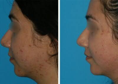 laser-resurfacing Before and after laser skin resurfacing in princeton