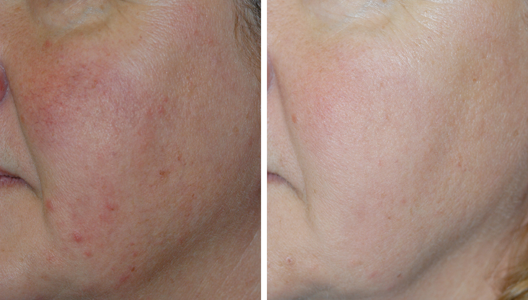 Brunner-rosacea-treatment-princeton patient before and after rosacea treatment in princeton, NJ