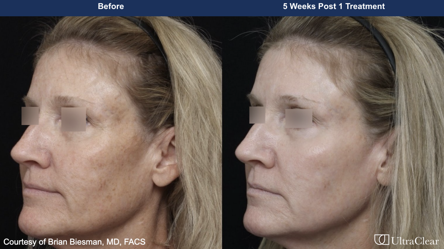 Female patient before and after laser resurfacing with UltraClear in Princeton