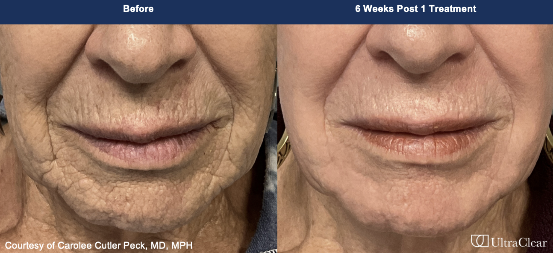 Laser Coring before and after photos