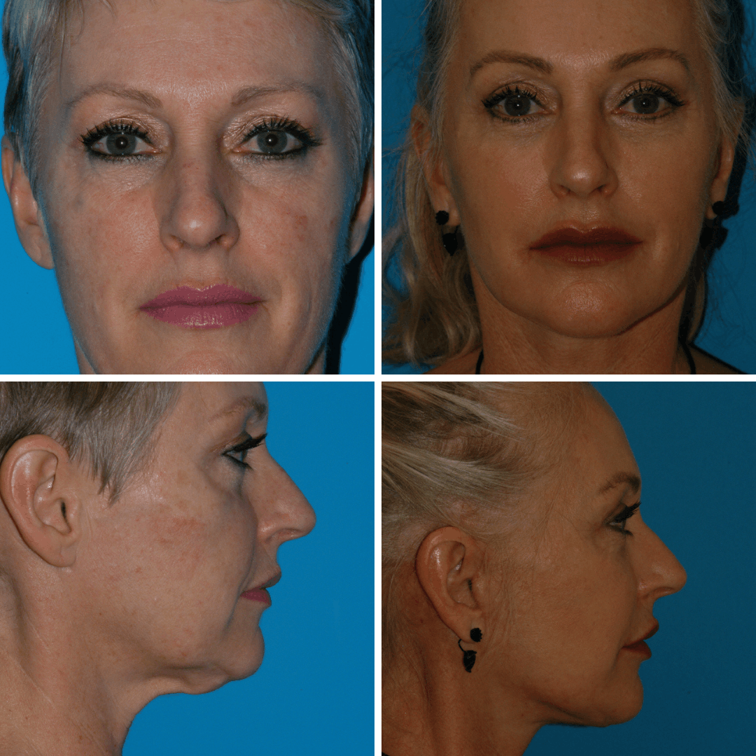 Facelift before and after photos by Dr. Eugenie Brunner