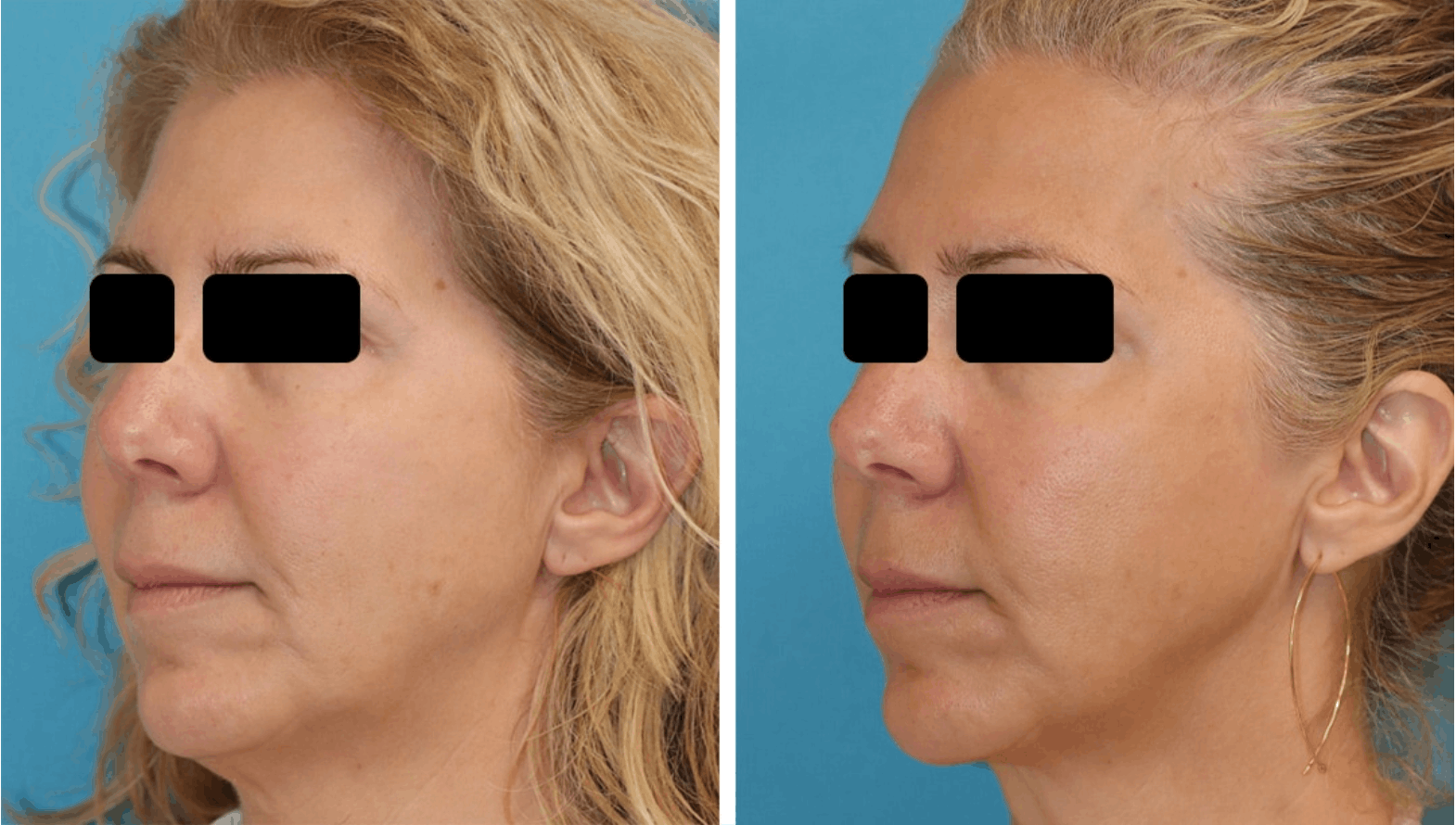 Before and after photos of a female patient