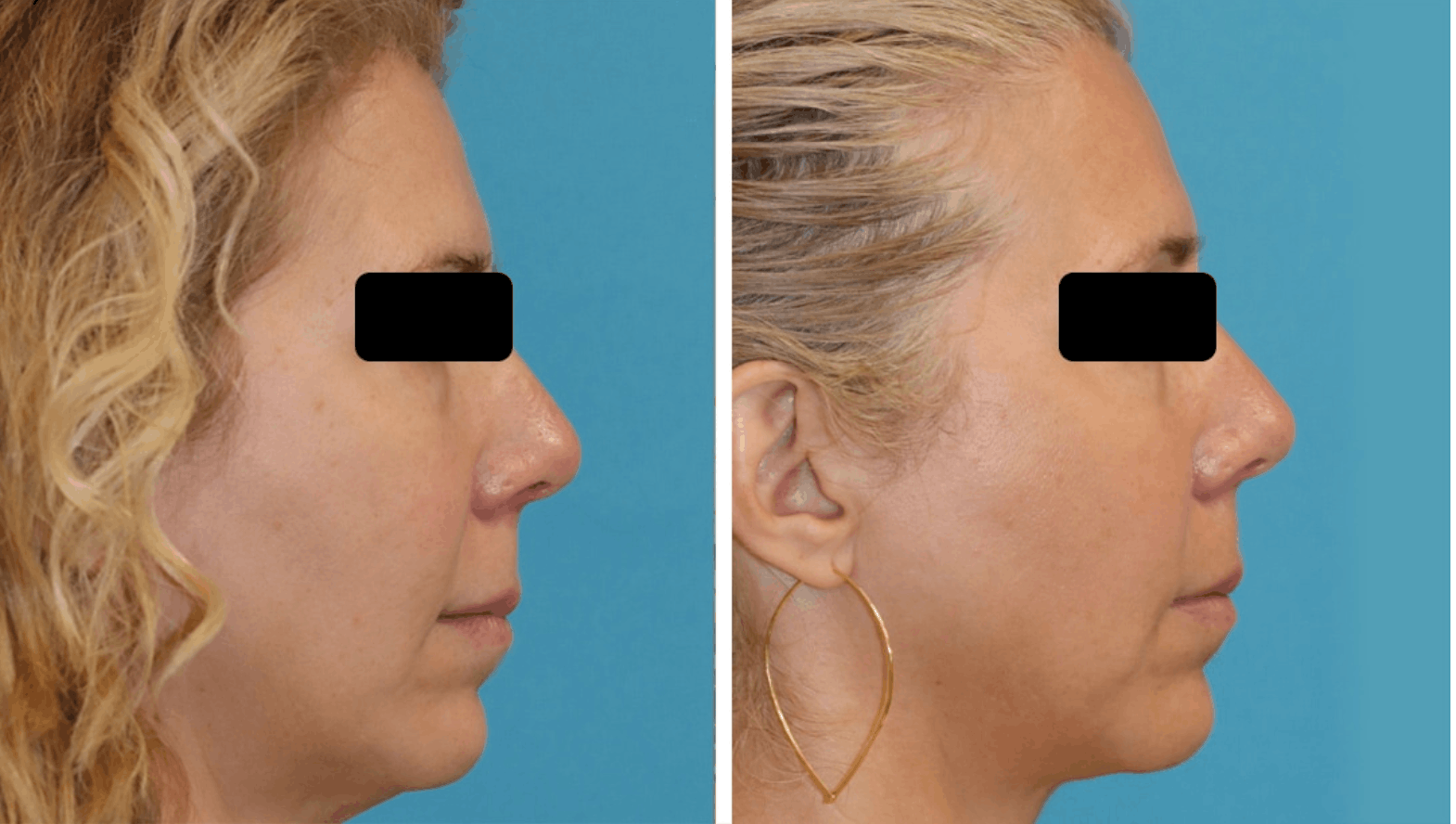 Before and after photos of a female patient