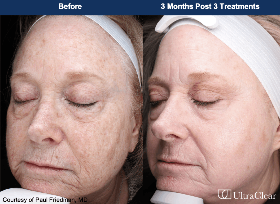 UltraClear before and after photos