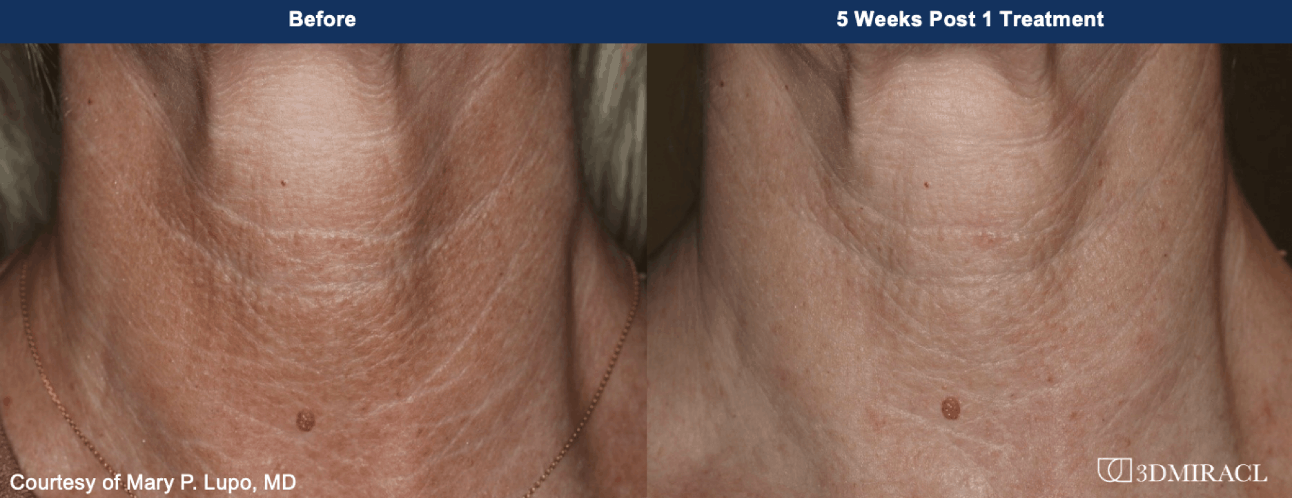 3DMIRACL Before and After photos of a female patient
