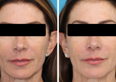 3DMIRACL for facial skin rejuvenation and improving crepey neck skin. This quick treatment requires minimal social downtime and topical numbing is optional