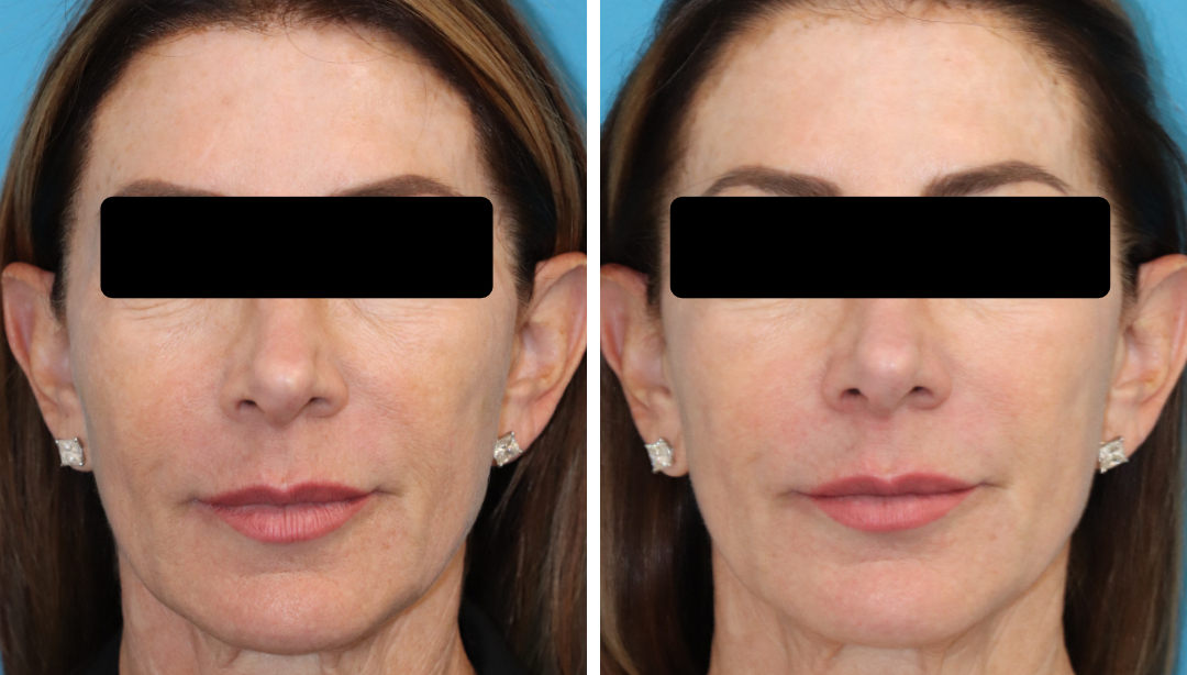 3DMIRACL for facial skin rejuvenation and improving crepey neck skin. This quick treatment requires minimal social downtime and topical numbing is optional