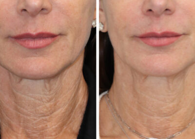 3DMIRACL for facial skin rejuvenation and improving crepey neck skin. This quick treatment requires minimal social downtime and topical numbing is optional