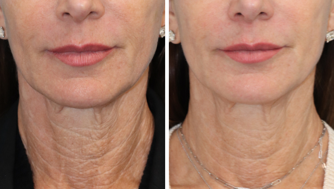 3DMIRACL for facial skin rejuvenation and improving crepey neck skin. This quick treatment requires minimal social downtime and topical numbing is optional