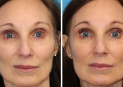 3DMIRACL for overall facial rejuvenation and sun damage. This quick treatment requires minimal social downtime and topical numbing is optional