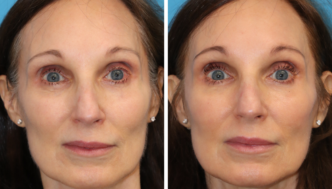 3DMIRACL for overall facial rejuvenation and sun damage. This quick treatment requires minimal social downtime and topical numbing is optional