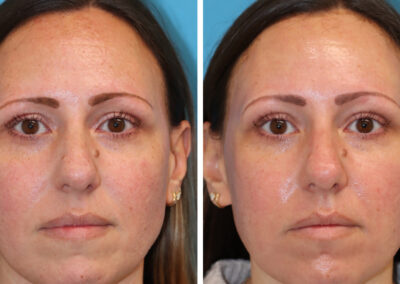 UltraClear for acne scarring and sun damage