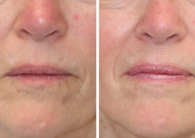 UltraClear for lines around the mouth and sun damage