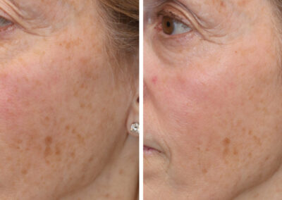 UltraClear for lines around the mouth and sun damage