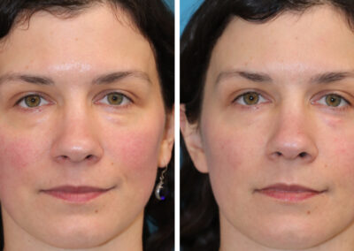UltraClear for under eye rejuvenation and 3DMIRACL for overall facial rejuvenation