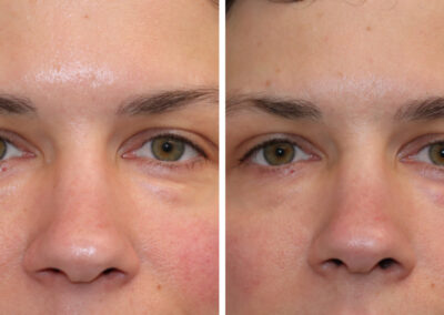 UltraClear for under eye rejuvenation and 3DMIRACL for overall facial rejuvenation