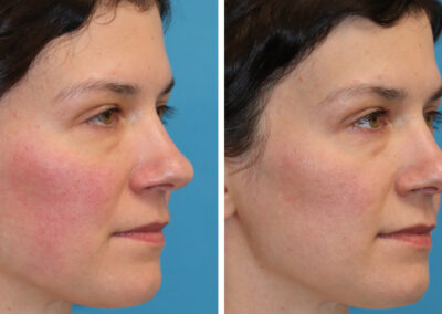 UltraClear for under eye rejuvenation and 3DMIRACL for overall facial rejuvenation