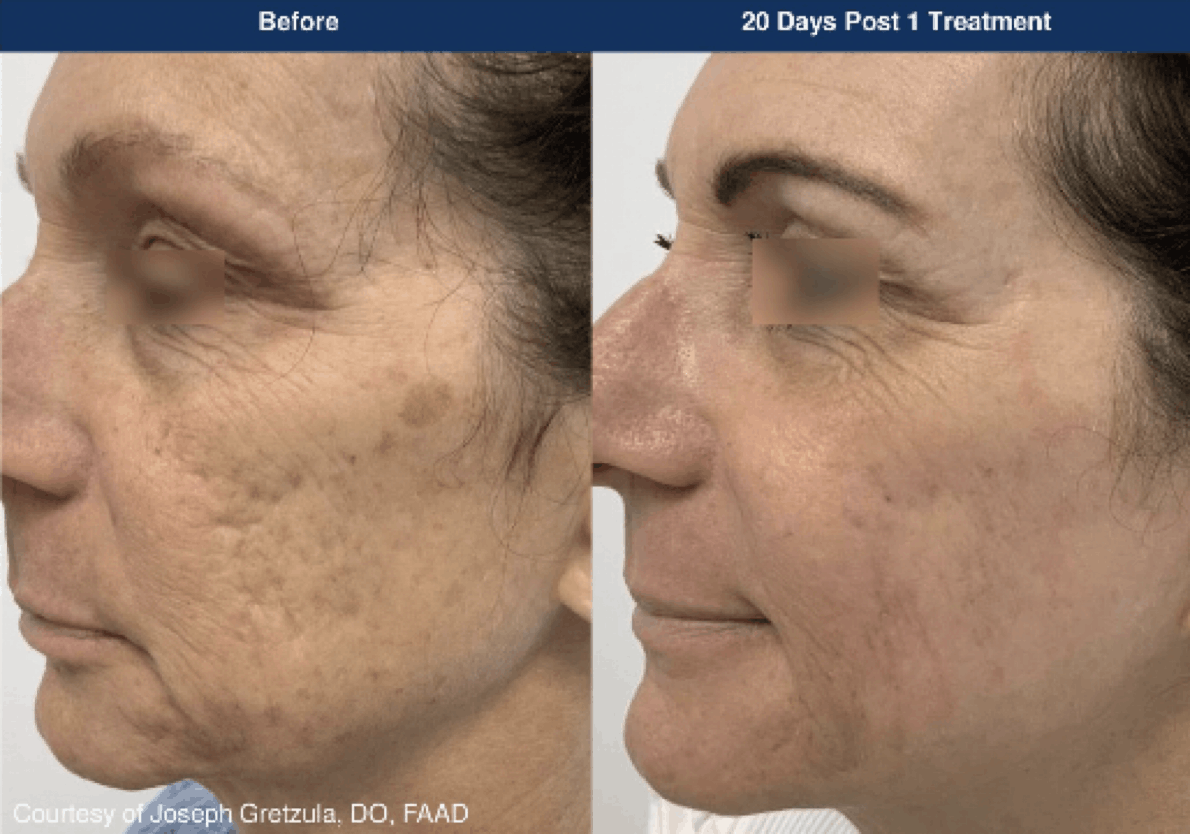 Ultraclear before and after photos