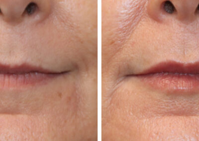 Dermal Fillers for Lip Rejuvenation before and after photos